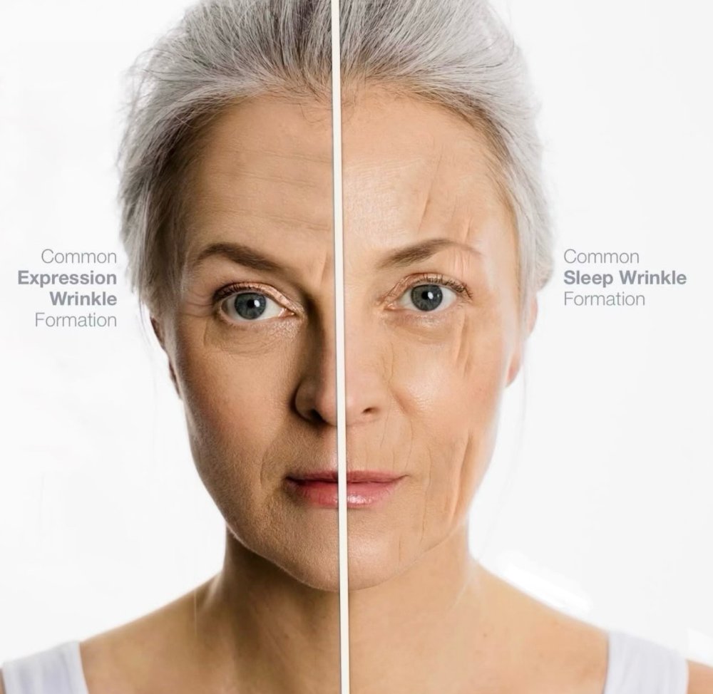 Comparison of expression-line formation and sleep-line formation on the face